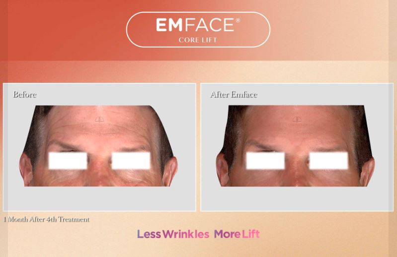Luminisce introduces EMFACE, a ground-breaking anti-aging technology